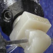 A ceramic crown being milled chairside to be fitted in a patient’s mouth