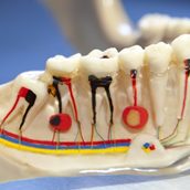 A model of the rotary endodontic system being used for a root canal