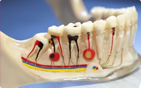 A model of the rotary endodontic system being used for a root canal